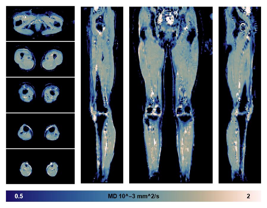 IVIM corrected whole leg muscle mean diffusivity obtained from diffusion tensor imaging.